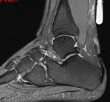 Figure 5 for case Achilles tendon tear and calcaneonavicular coalition (RID3801)(RID3184)